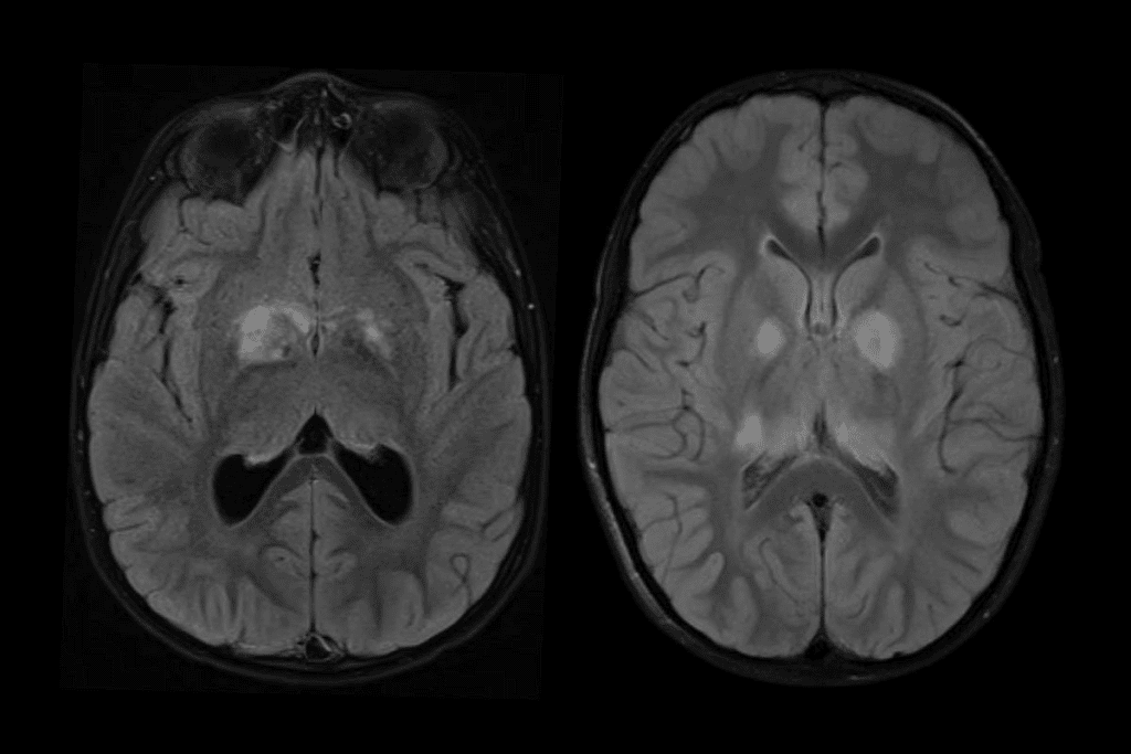 Brain Tumor Biopsy: 7 Key Facts 1 Brain Tumor Biopsy: 7 Key Facts