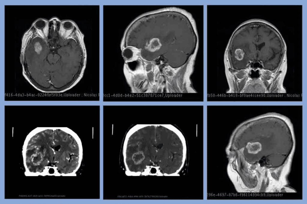 Mass on Brain MRI: 8 Common Tumors