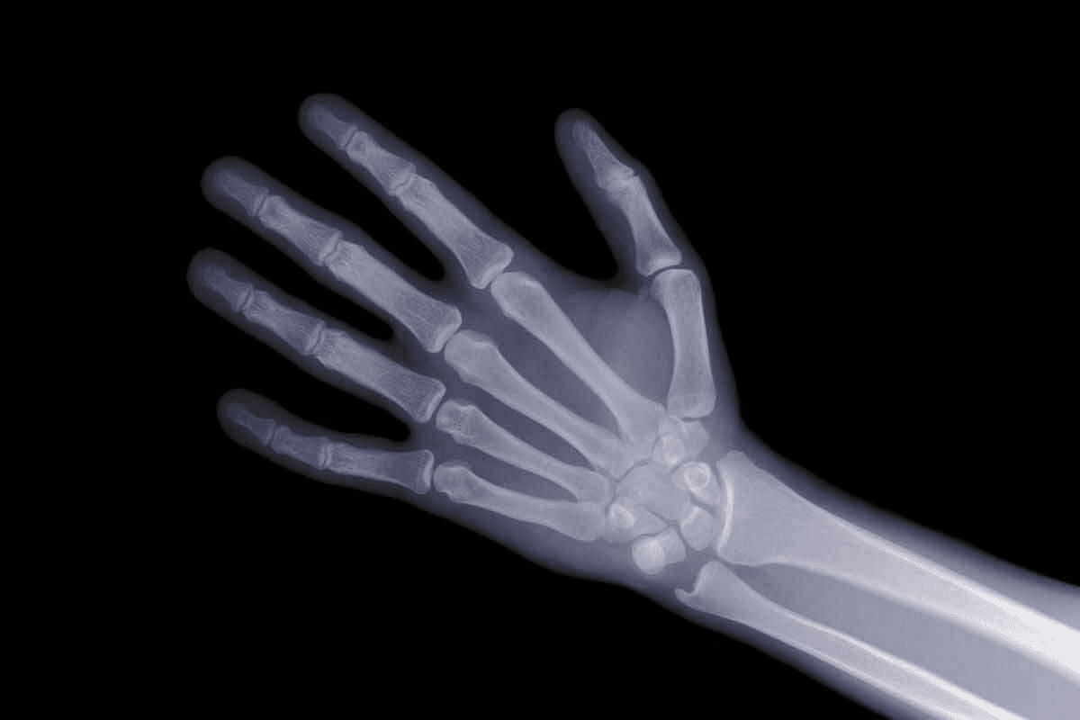 What Causes Increased Uptake on Bone Scan?