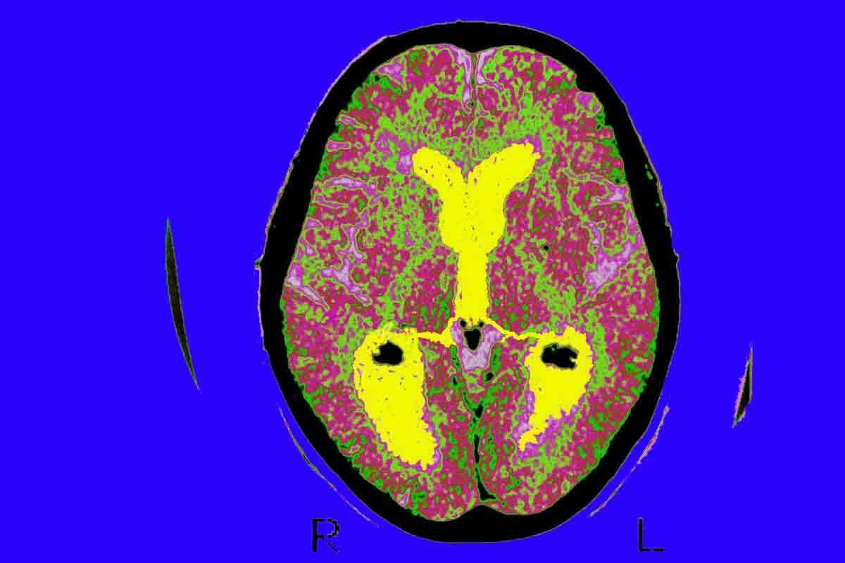 Brain CT Scan or MRI: Which Is Better for Tumor Detection?