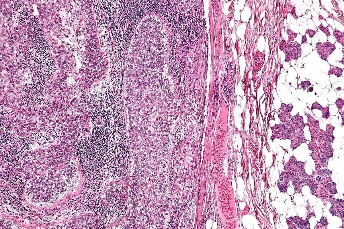 Alveolar Rhabdomyosarcoma: 7 Key Facts
