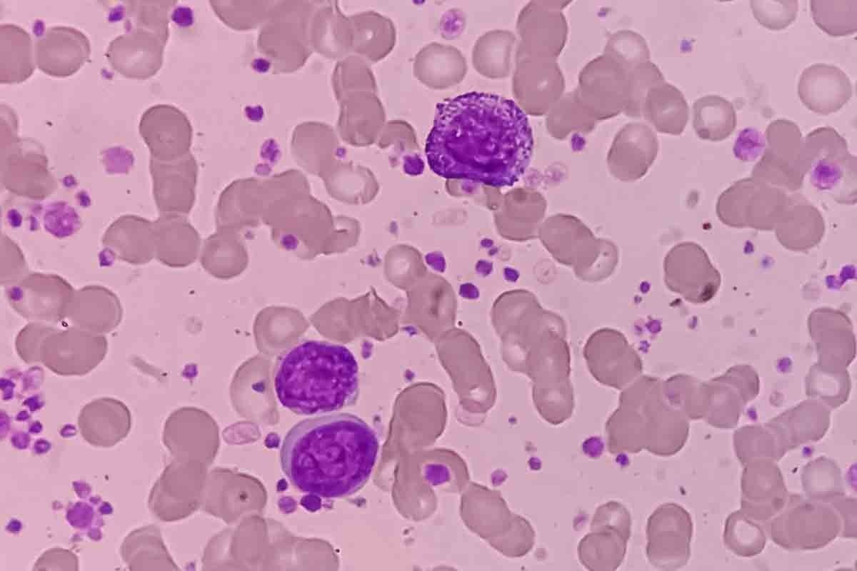Symptoms of Leukemia Petechiae: 11 Key Signs