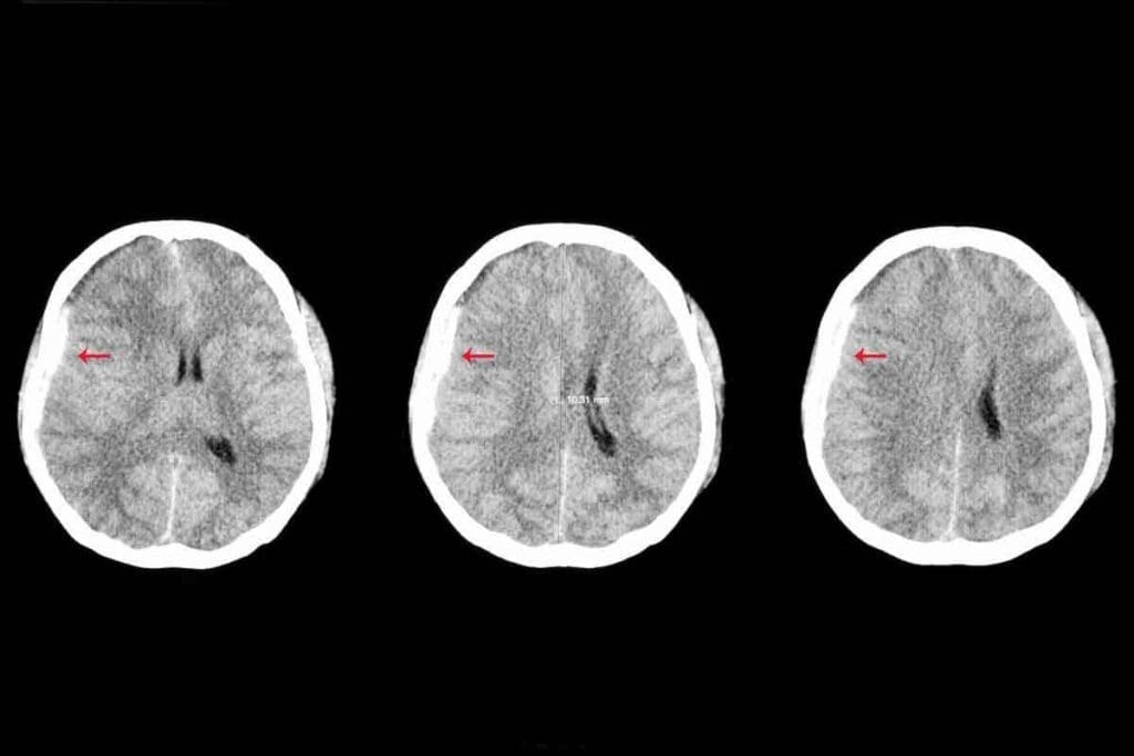 How Accurate Is CT Scan for Brain Tumor?