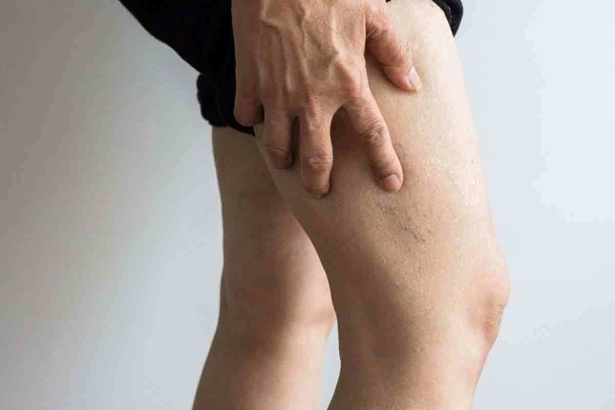 Can You Get Deep Vein Thrombosis (DVT) in Your Arm or Shoulder? Symptoms, Risks, and What to Do