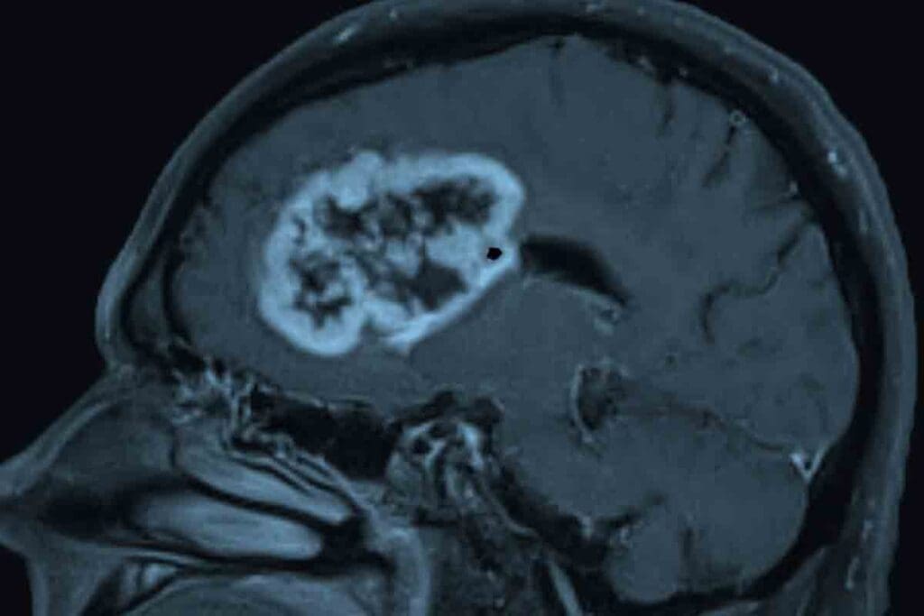 What Is Pediatric Glioblastoma Multiforme? Causes & Treatment 2 What Is Pediatric Glioblastoma Multiforme? Causes & Treatment