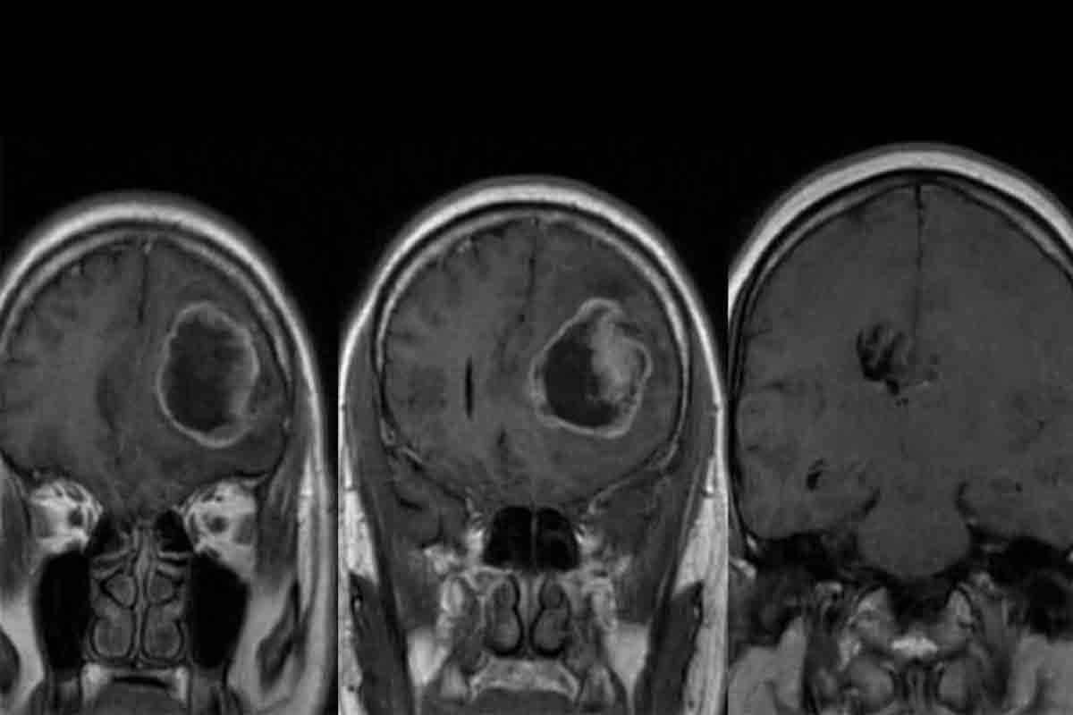 What Is Pediatric Glioblastoma Multiforme? Causes & Treatment