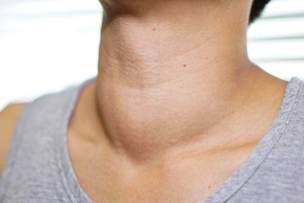 10 Key Symptoms and Risks of a Clot on the Neck You Should Know