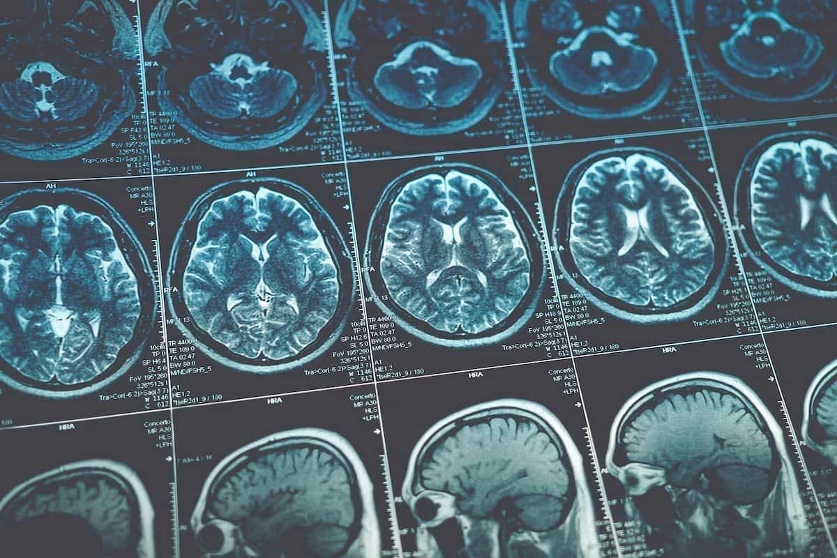 7 Key Facts About Grade 3 Brain Tumor and Its Stages