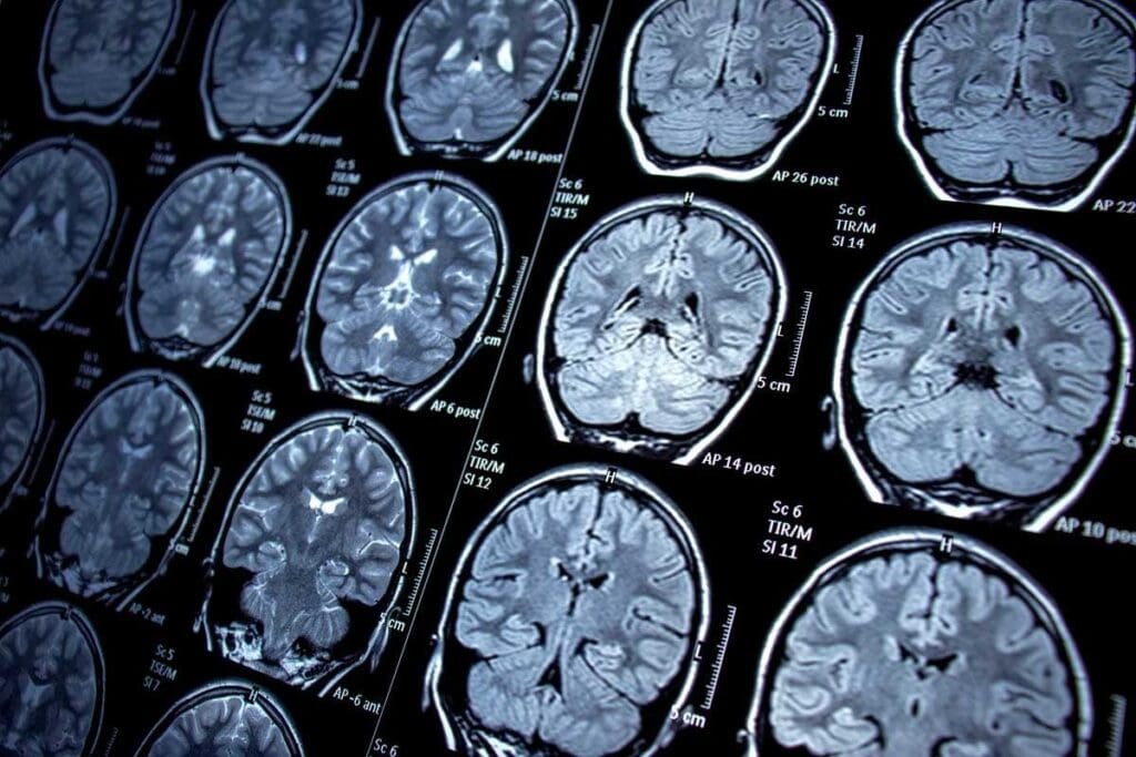 Understanding Grade 2 Brain Tumor: 7 Key Facts and Stages