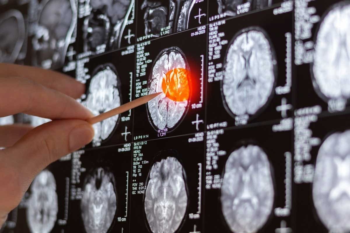 Prognosis and Survival Rates for Grade 3 Primary Brain Cancer