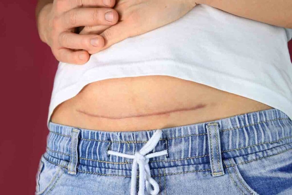 Adhesion Removal: How to Manage This Painful Problem 1 Adhesion Removal: How to Manage This Painful Problem