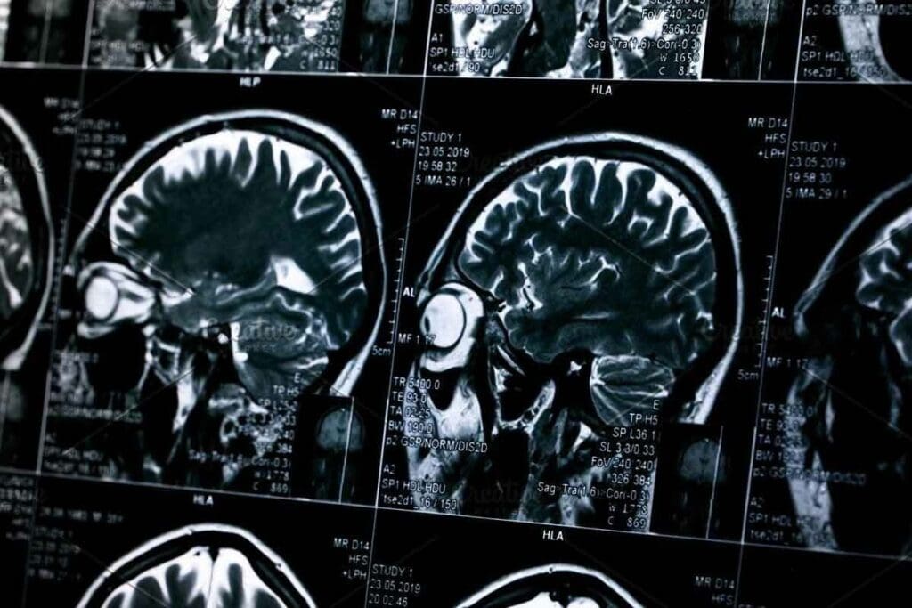 PET Scan vs MRI Brain: 7 Key Differences