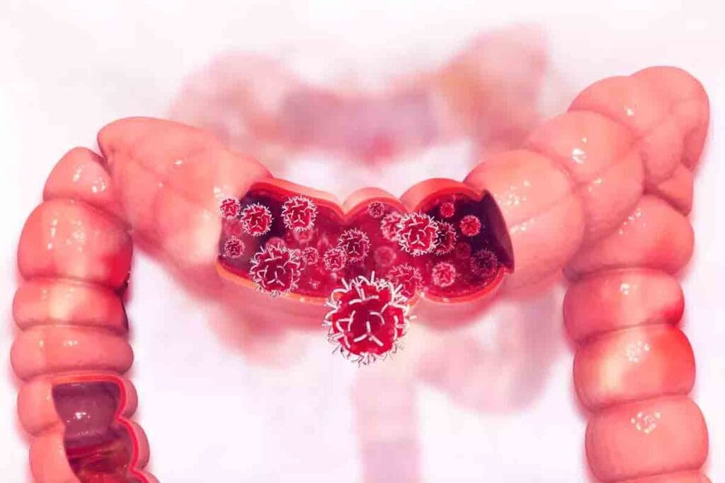 Colon and Small Bowel Lysis of Adhesions: 5 Key Facts