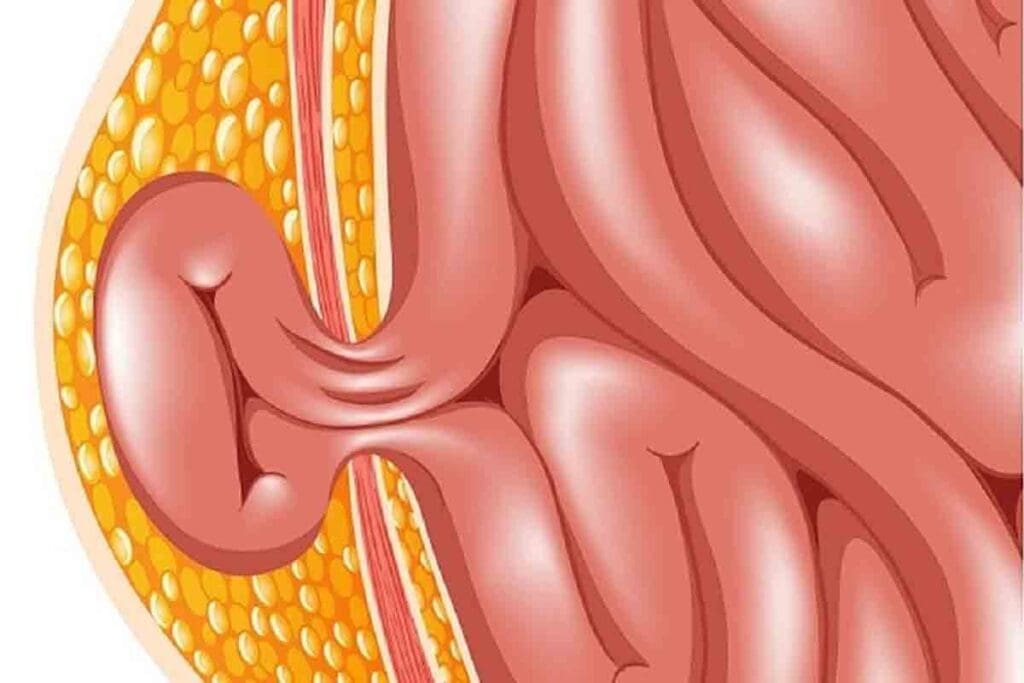 Ventral Hernia vs Umbilical: The Critical Facts