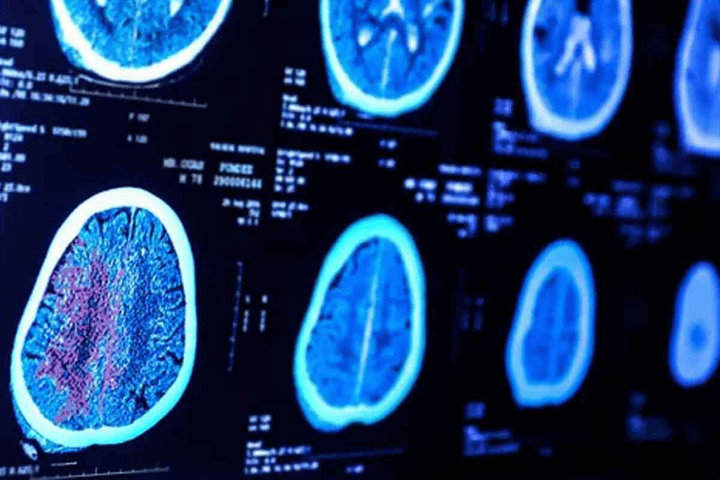 DaTscan Brain: Essential Test for Parkinson's Diagnosis