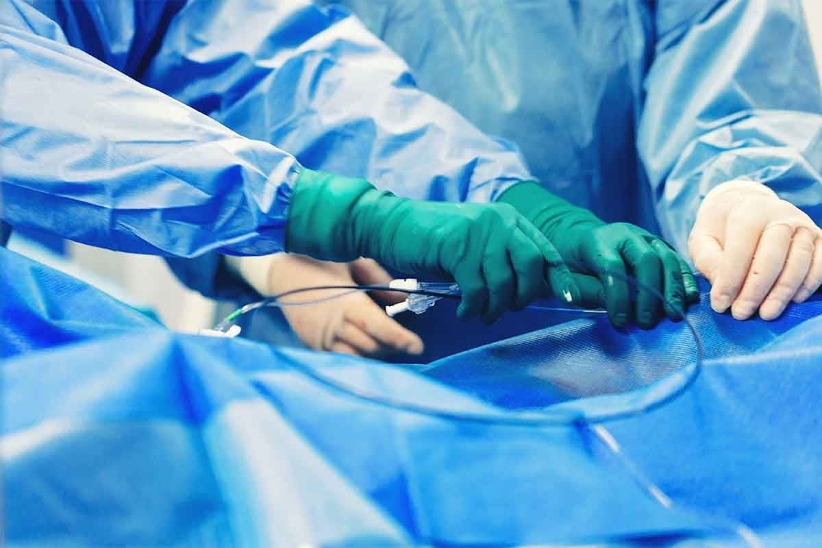 Endarterectomy vs Angioplasty: Key Facts