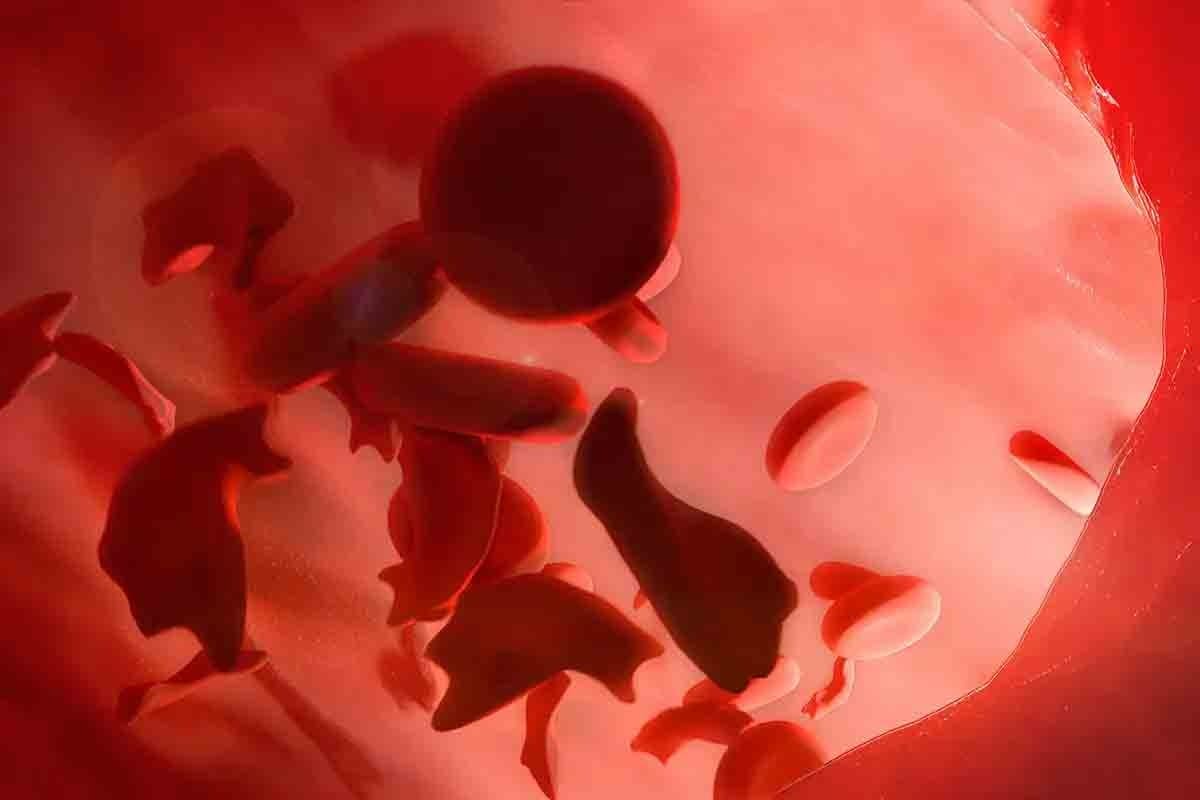 Why Does Sickle Cell Cause Pain?