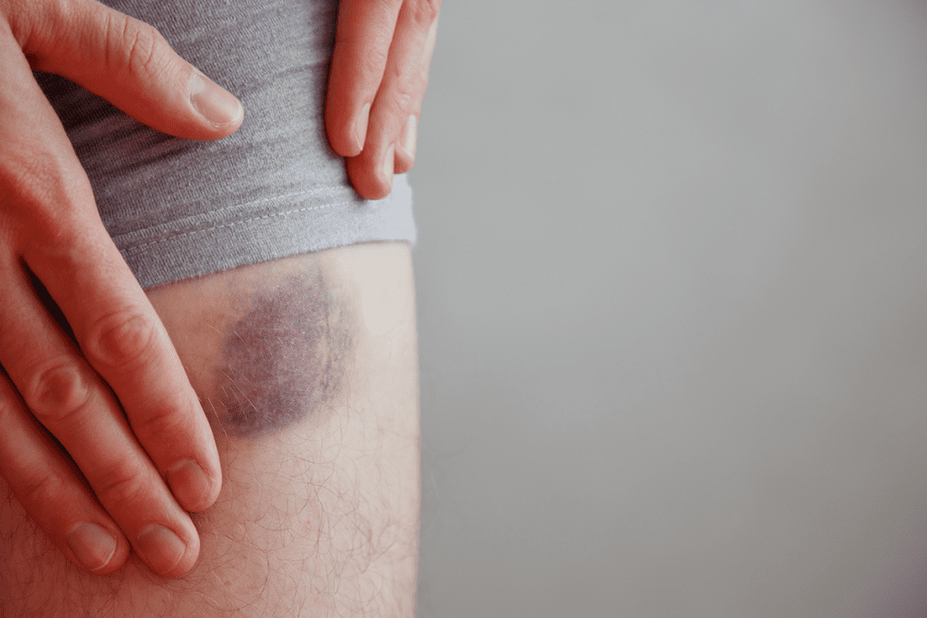 Bruising Easily: Dangerous Leukemia Bruise Sites