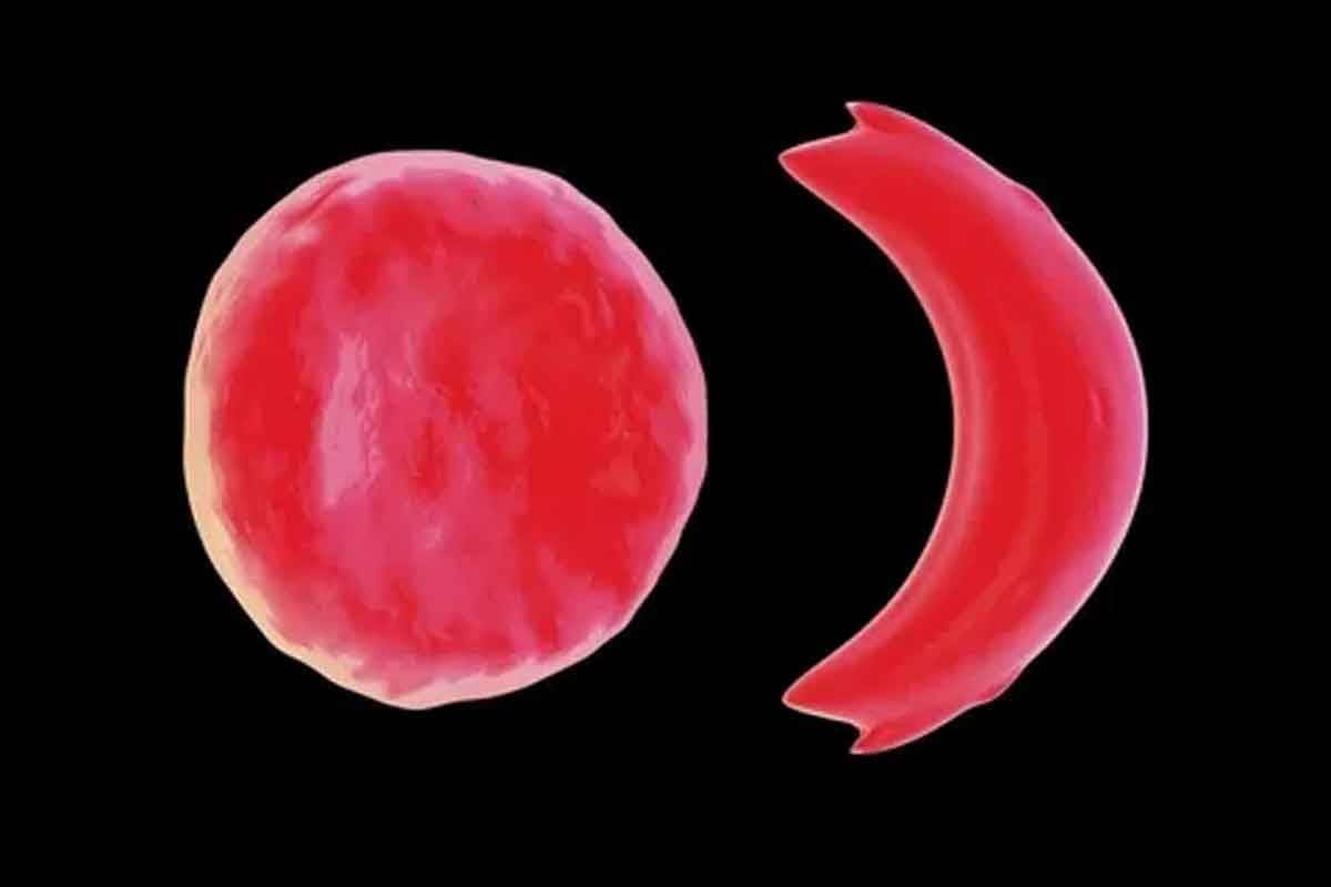 What Is a Sickle? Impact on Sickle Cell Disease