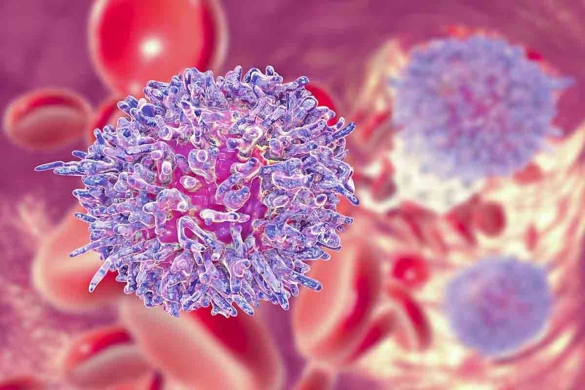 Lymphoblastic vs Lymphocytic Leukemia: 5 Key Differences