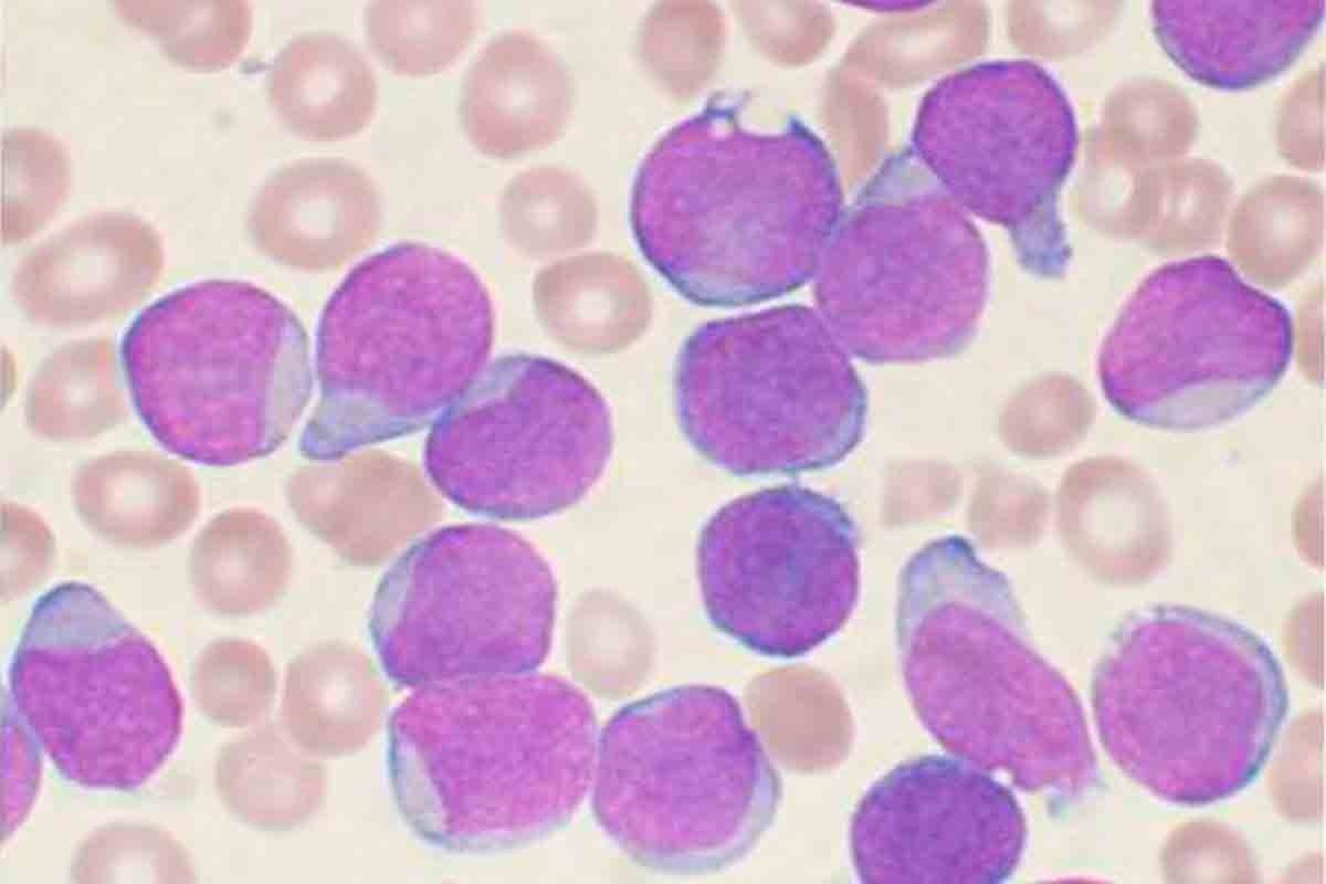 Complications of Acute Lymphocytic Leukemia