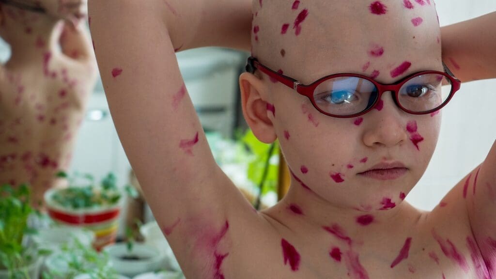 12 Key Brain Tumor Symptoms: Skin Rash, High Blood Pressure, and Early Warning Signs