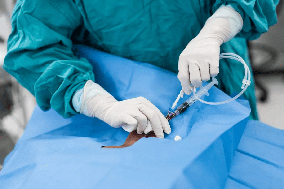 Catheter – What Happens If You Ejaculate While Wearing It