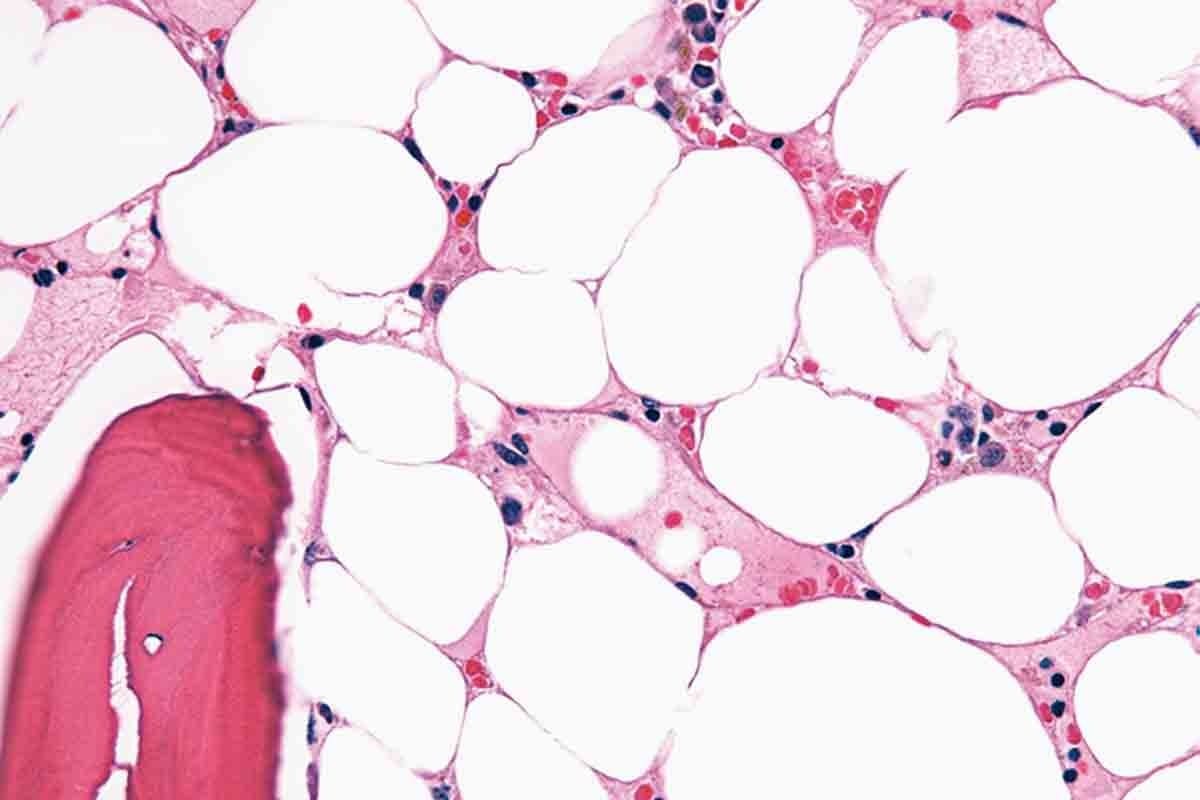 Pathophysiology Of Aplastic Anaemia: 12 Key Facts