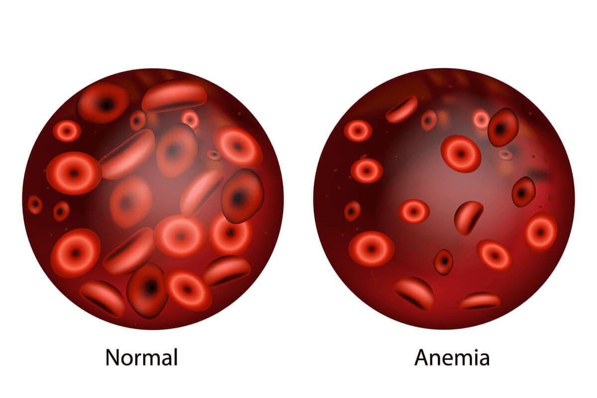 Aranesp: Amazing Drug for Cancer Anemia