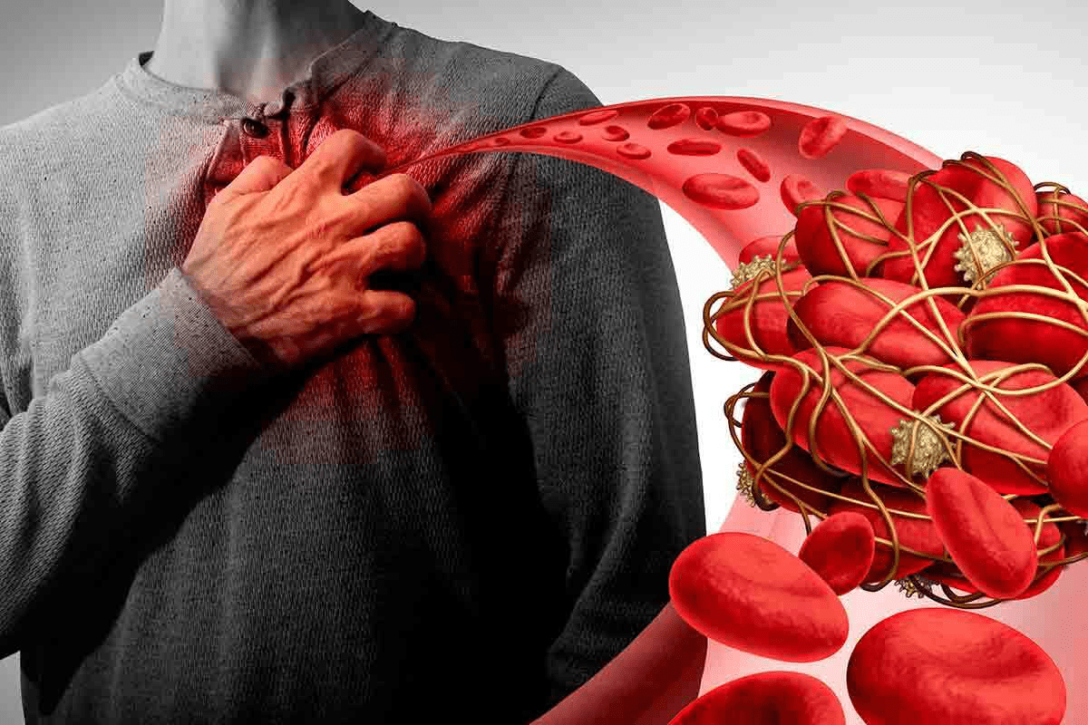 12 Medical Terms and Names of Blood Clots You Should Know