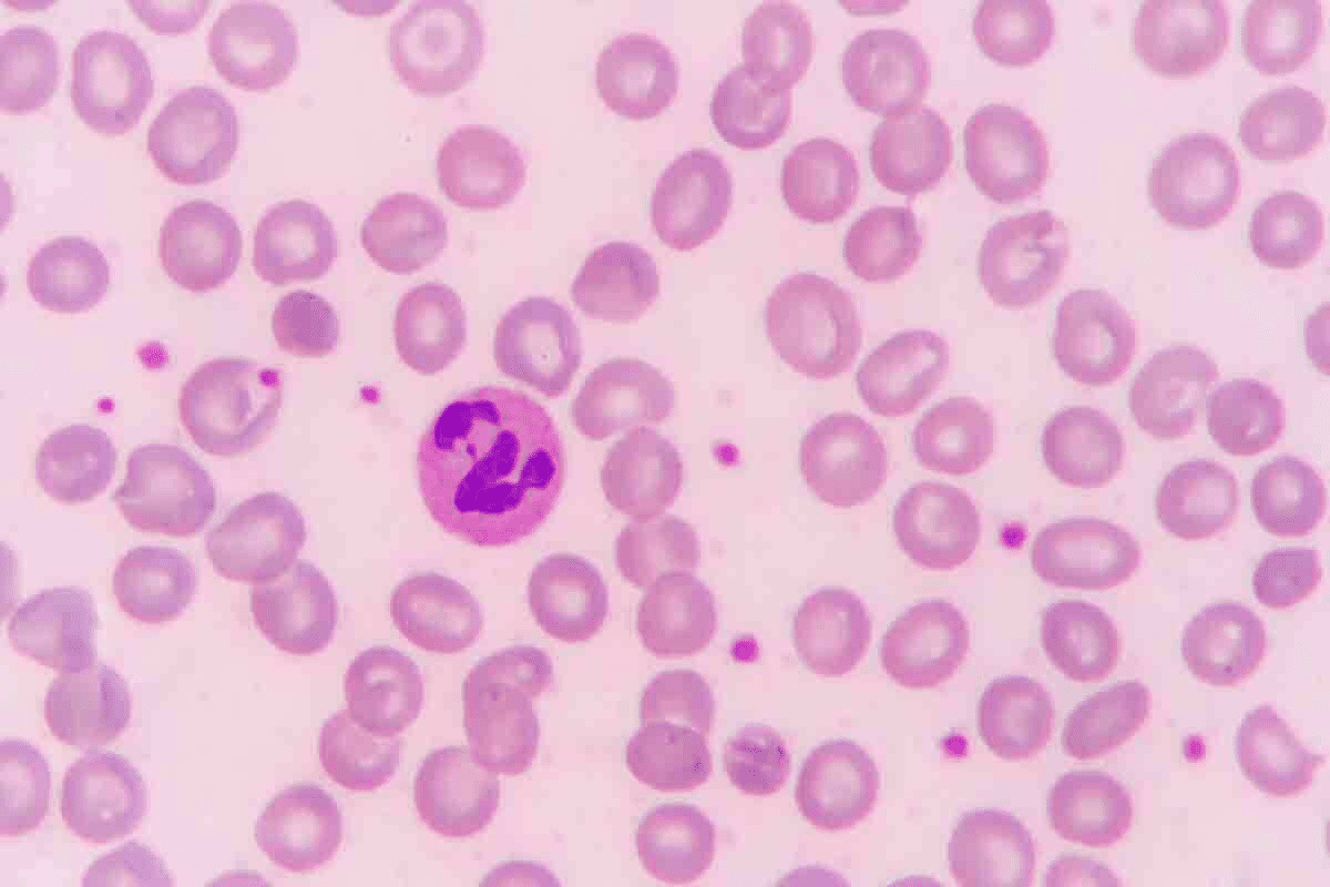 15 Common Blood Marrow Disorders and Non-Cancerous Bone Marrow Diseases
