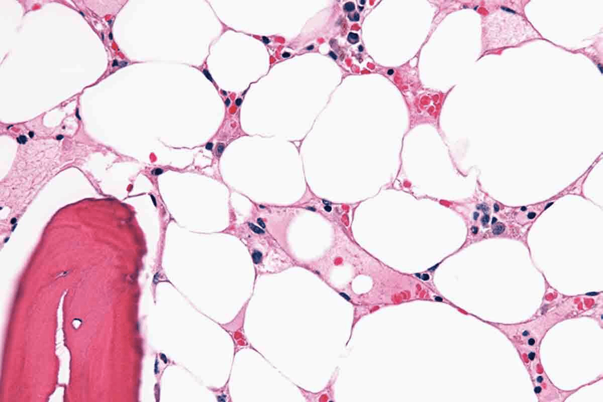 What Is Aplastic Anemia (bone marrow anemia) and How Does Bone Marrow Failure Cause It?