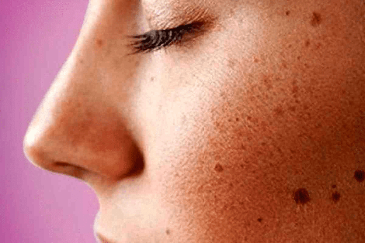 Skin Cancer on Scalp: What It Looks Like