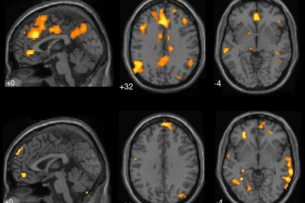 Cancer Metastasis to Brain: Progression