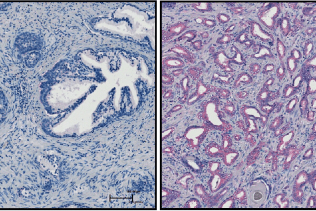 What Does Bacteria in Urine Indicate? Normal vs Infection 3 image 1761505084542 LIV Hospital