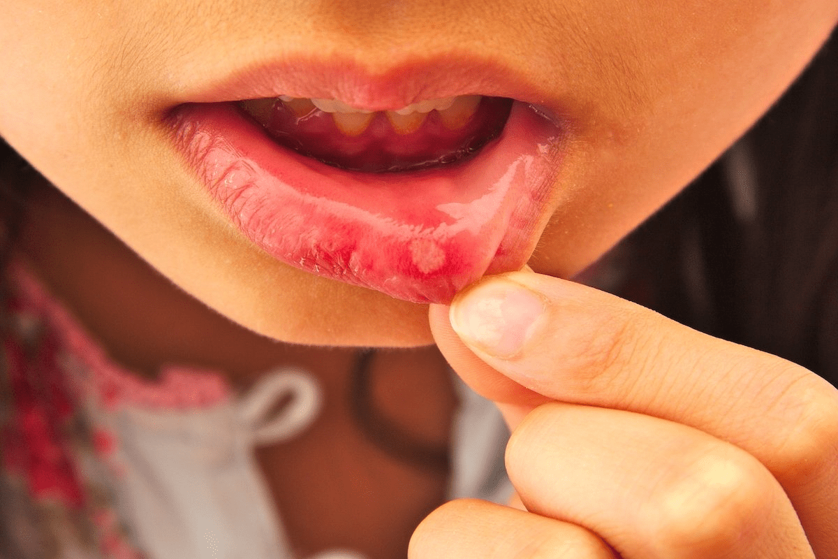 Viral Pharyngitis Treatment and Recovery