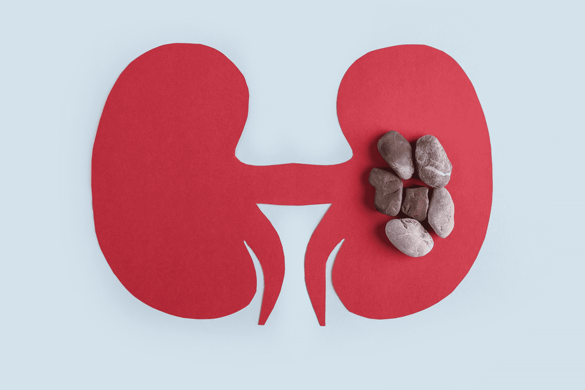 Black Kidney Stones in Urine: Prevention