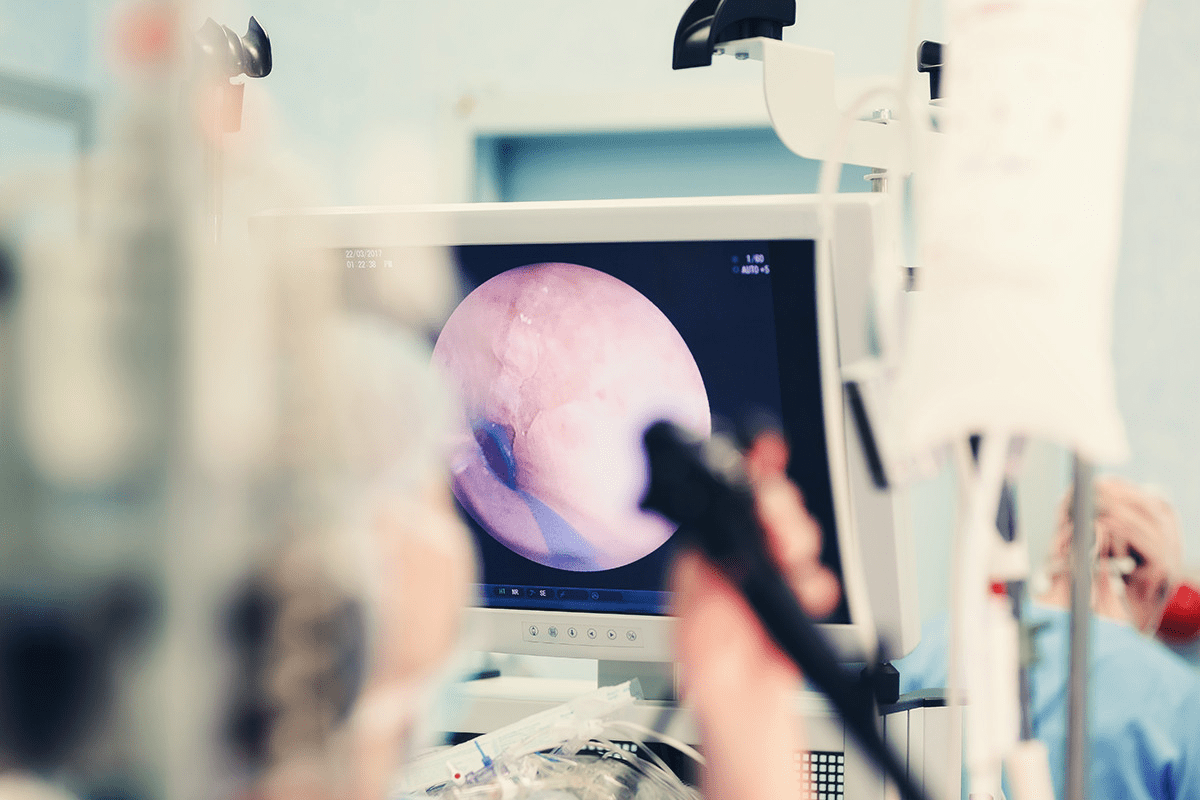 Bladder Stone Removal Without Surgery: How to Do It Safely 3 image 1761515415163 LIV Hospital