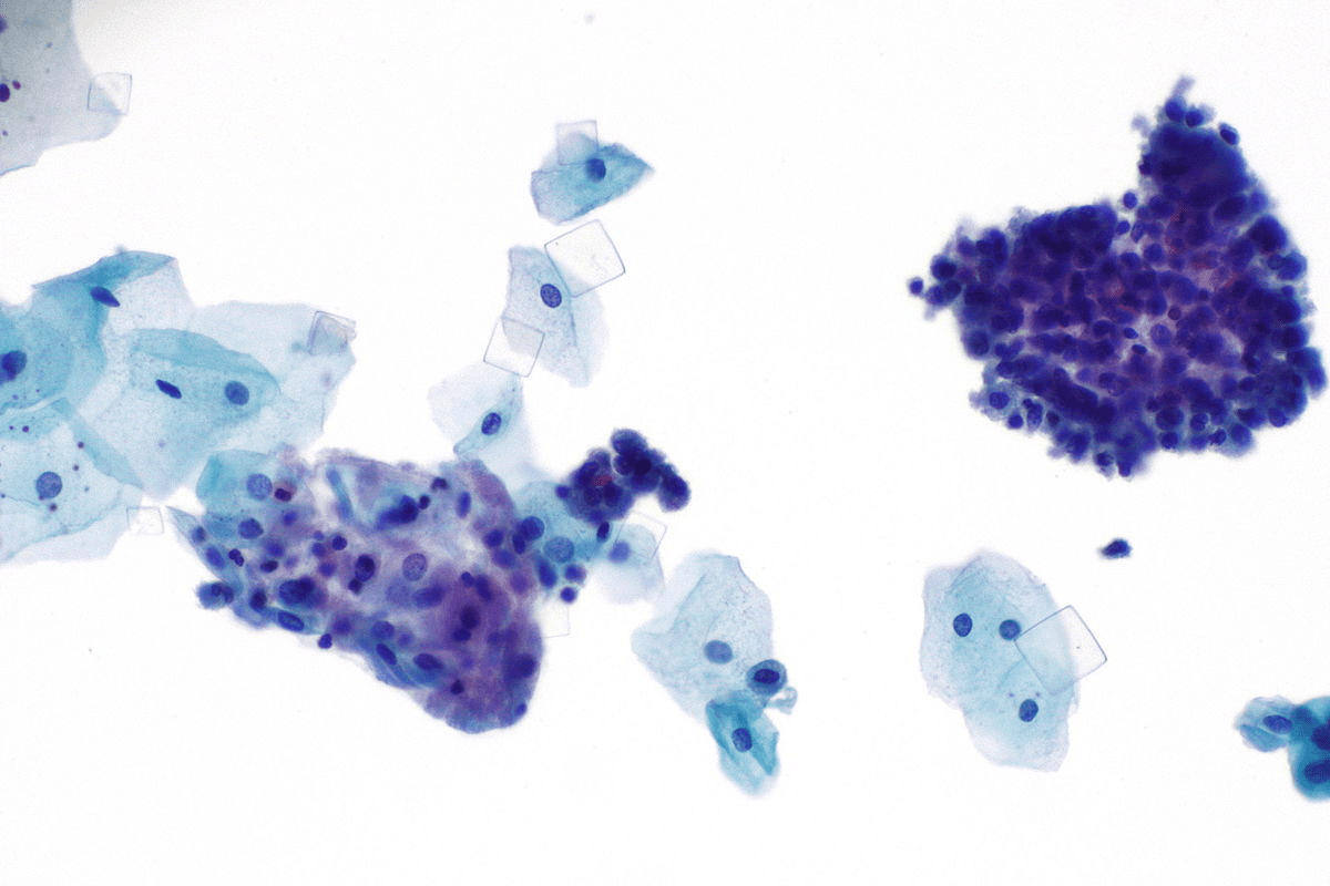 Urinary Crystals: Meaning & Causes Explained