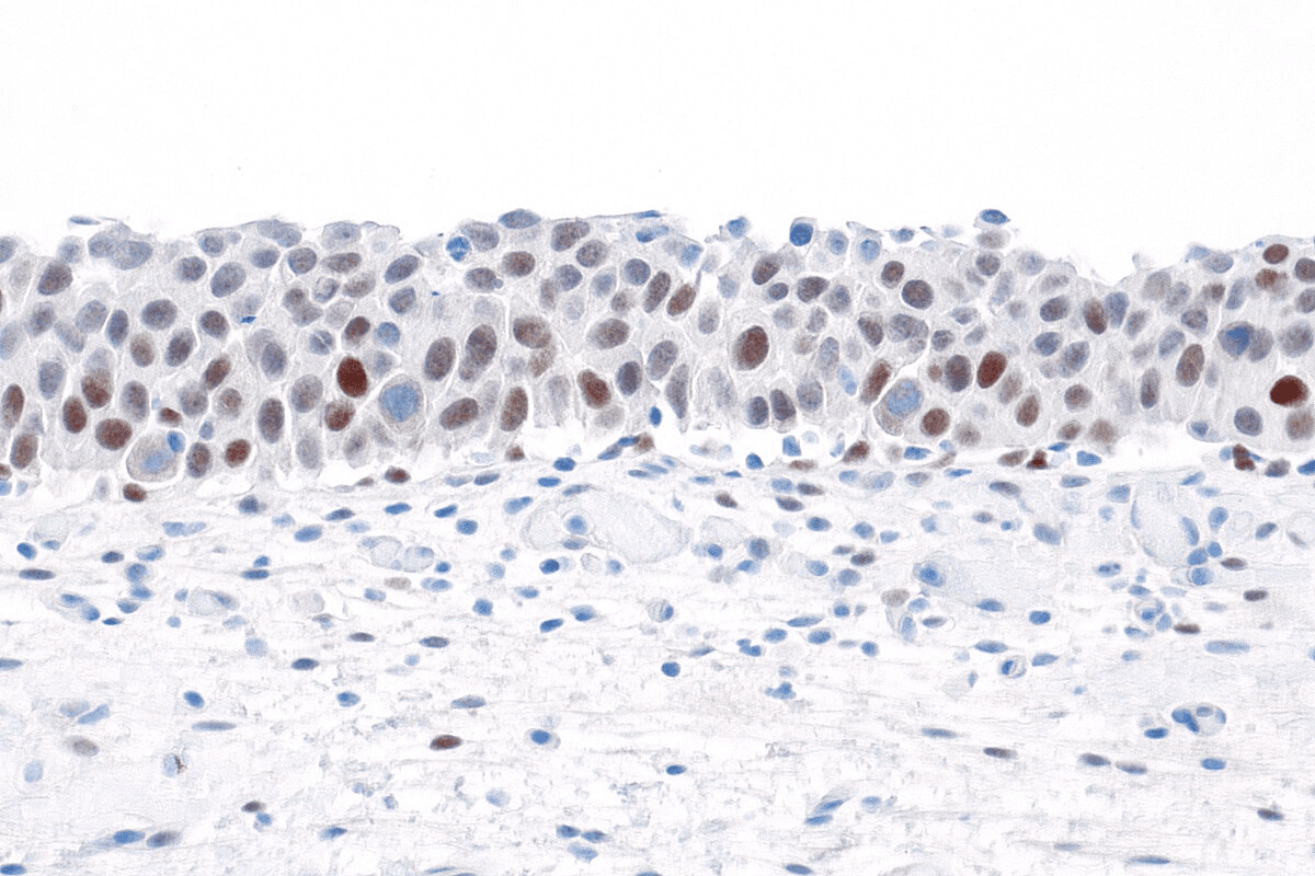 Uric Acid Renal Stones: Causes & Treatment 3 Uric Acid Renal Stones: Causes & Treatment