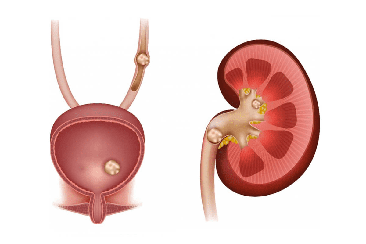 Does Kidney Stones Cause Chest Pain? 2 Does Kidney Stones Cause Chest Pain?