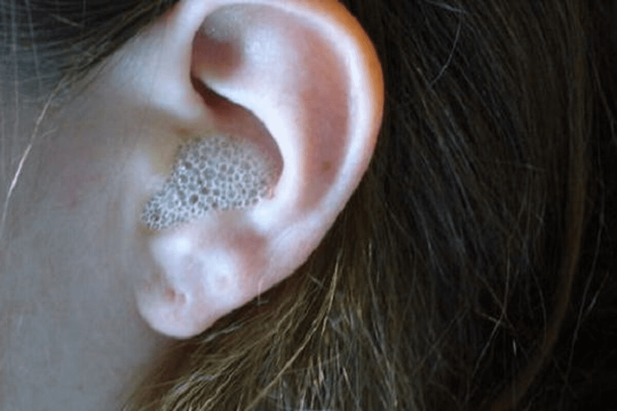 Lump Below Ear Cancer: Causes and Risk Assessment