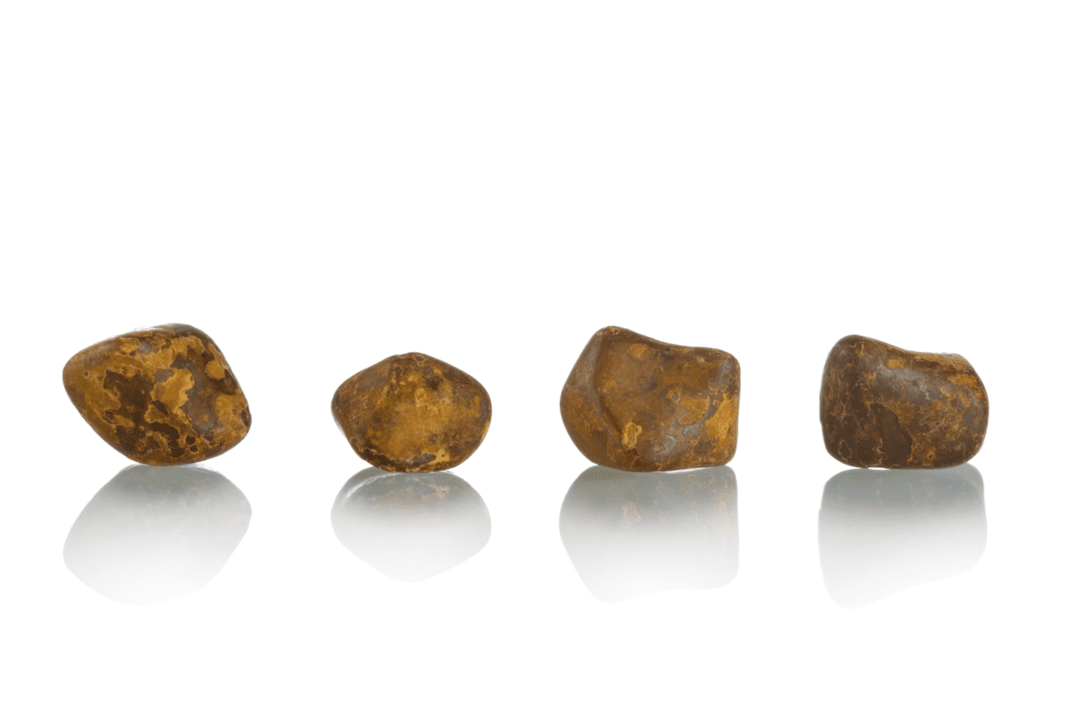 Can You Have Stones in Your Bladder? Complete Guide