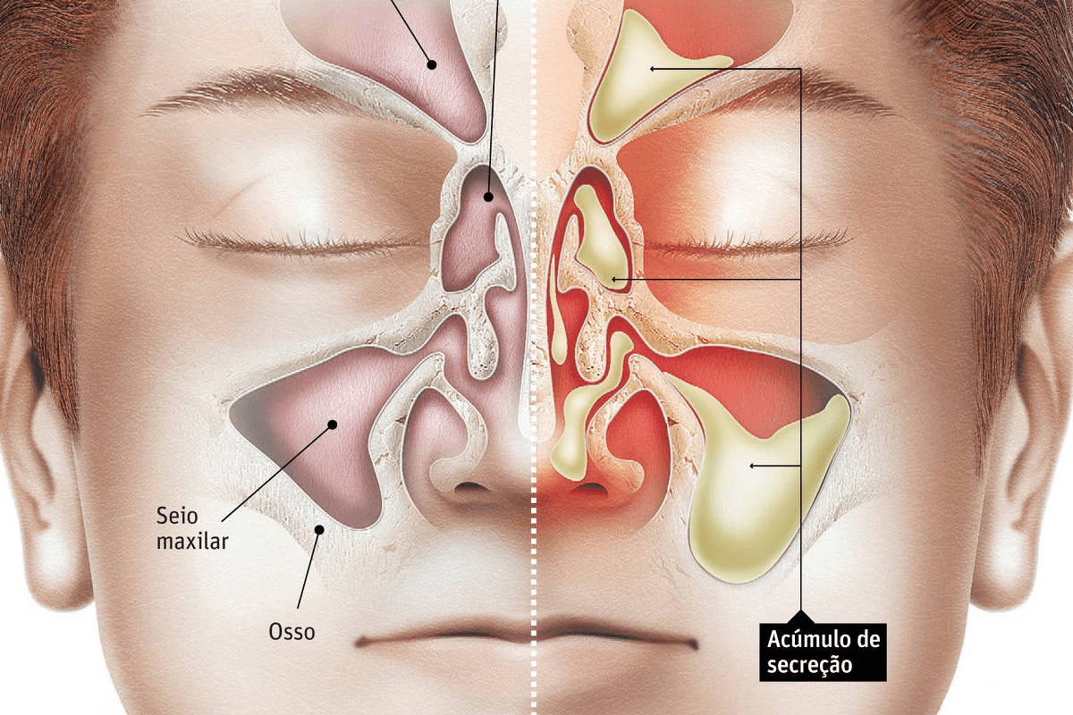 Sinus Dryness Symptoms: Quick Relief Solutions