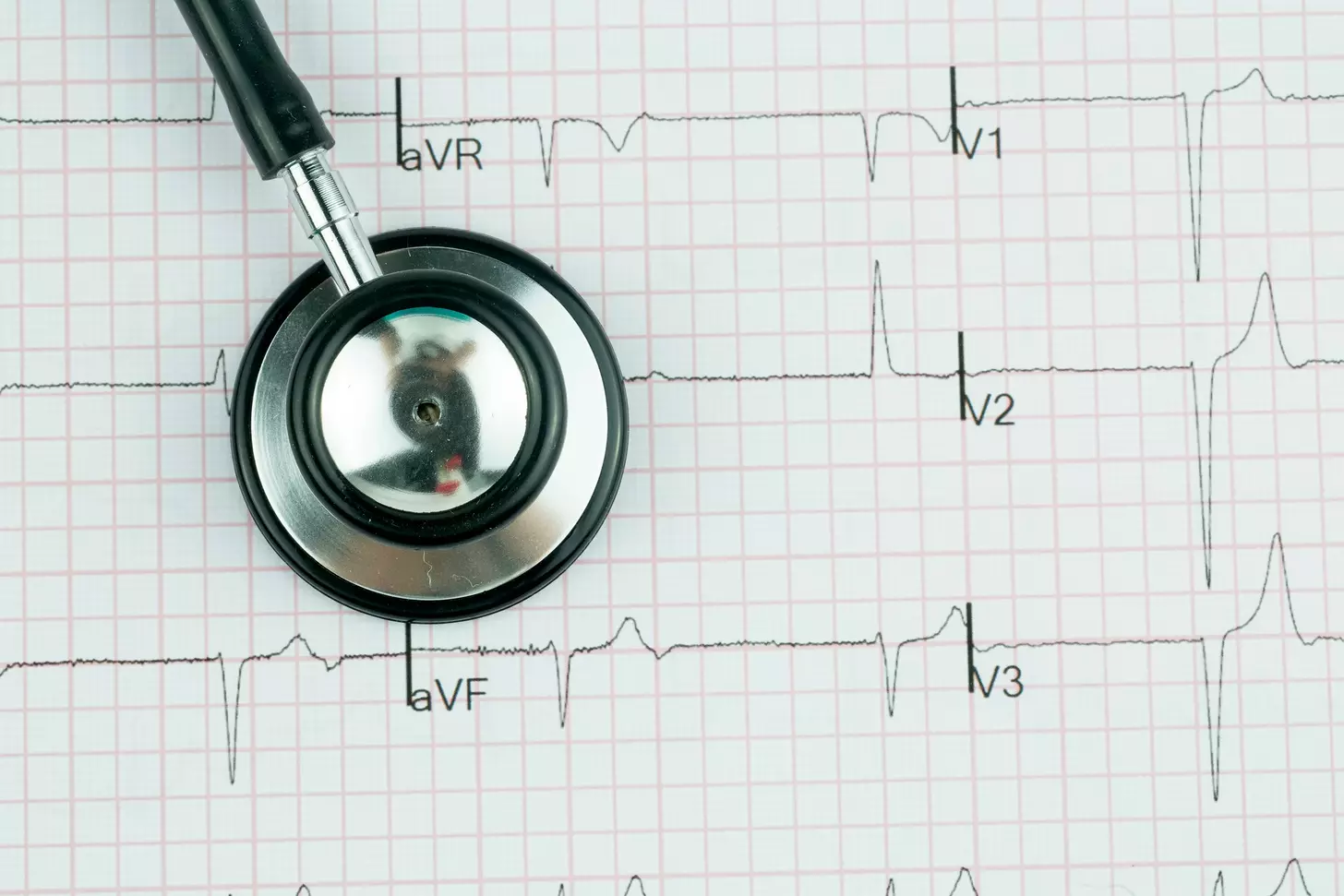 irregular sinus rhythm
