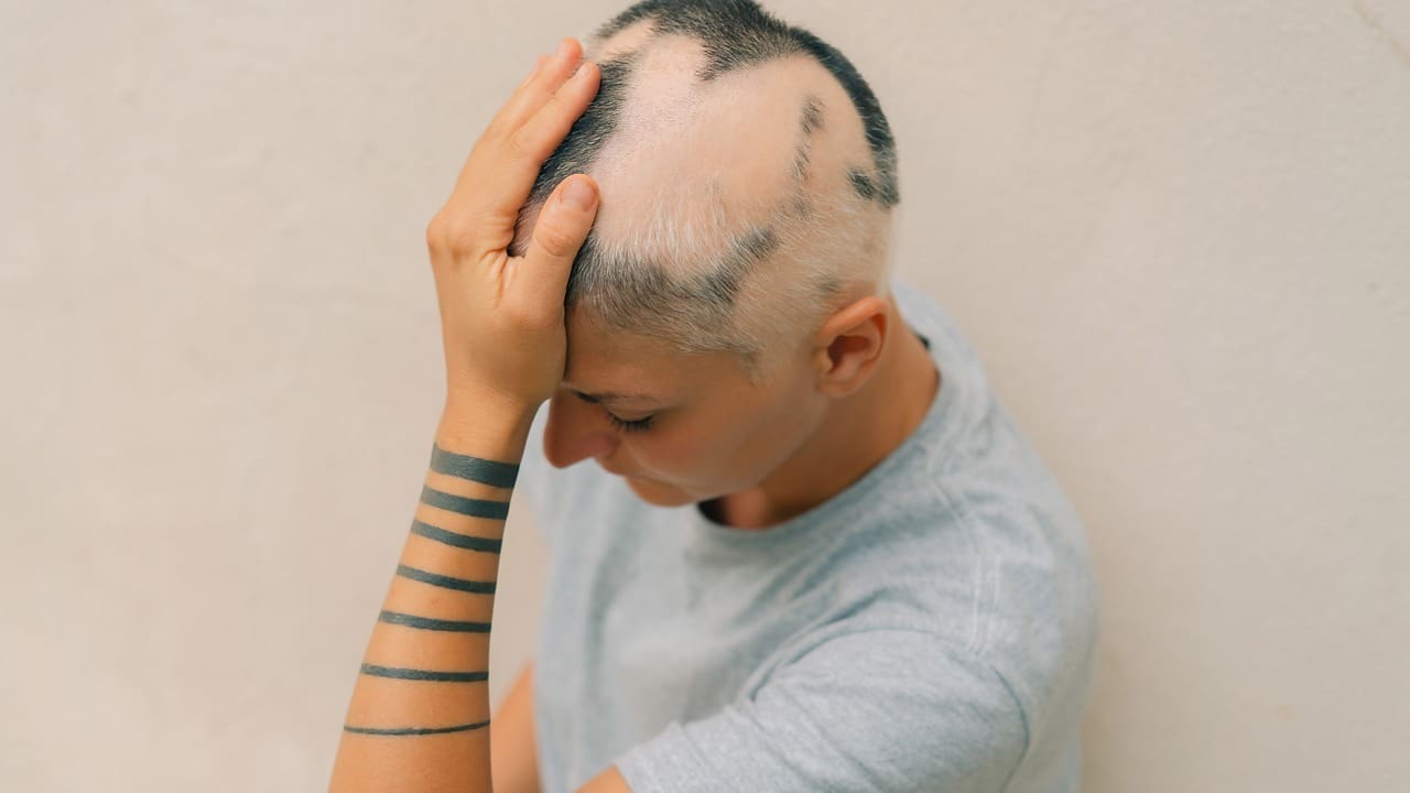 is hair loss a sign of brain tumor