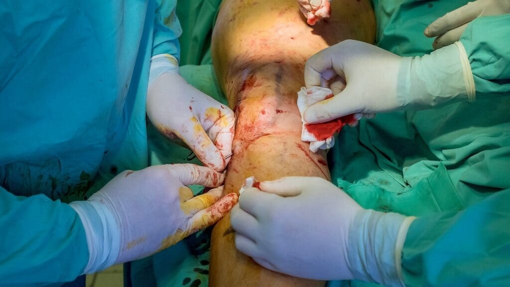 knee arthroscopy procedure