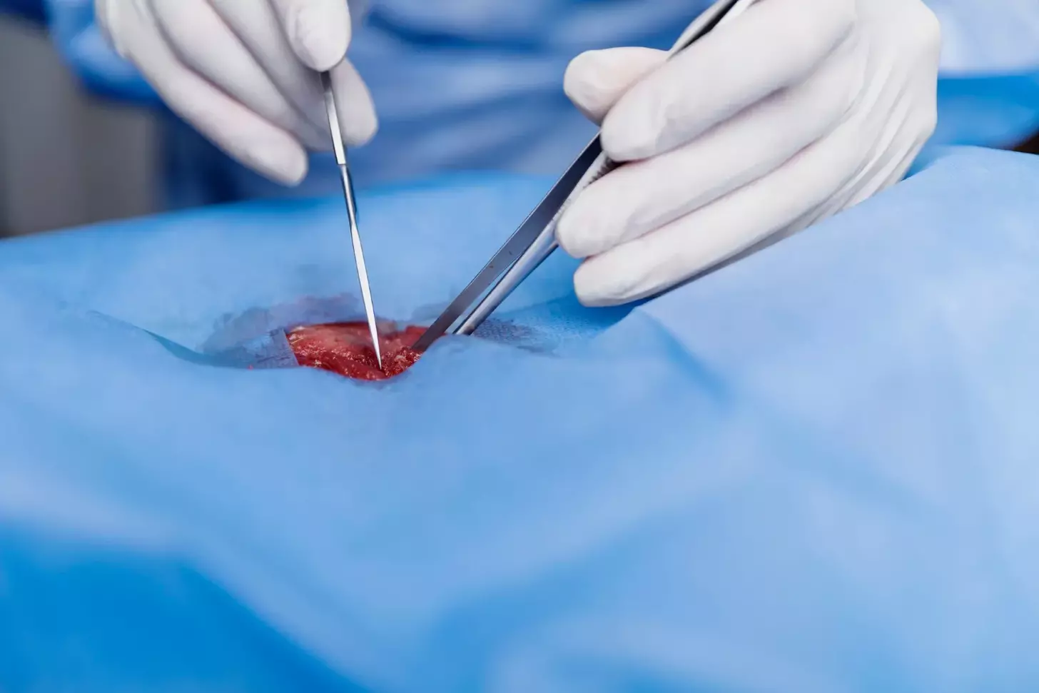 laparoscopic resection of endometriosis