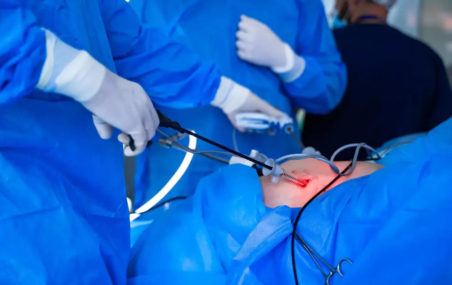 laparoscopic treatment for fibroids