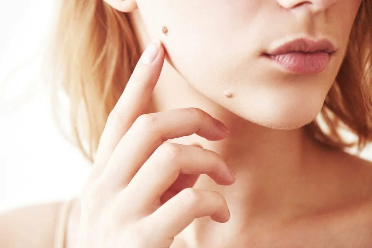 Mole on Face: A Shocking Guide for Worried Parents
